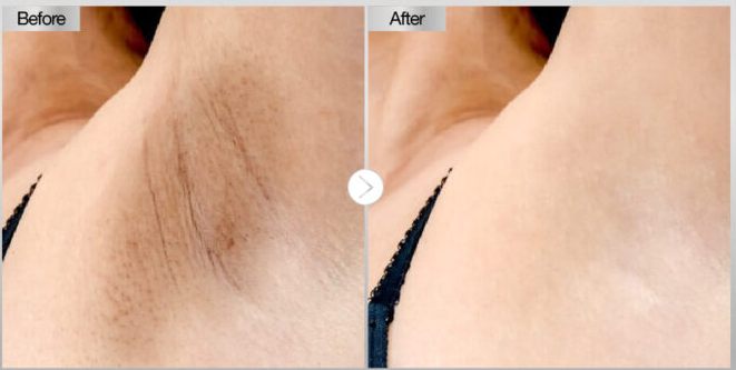 epilare definitiva laser craiova